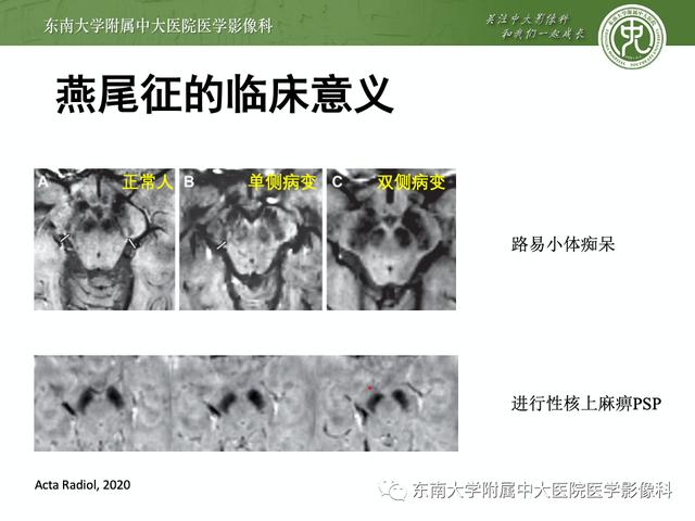 SWI的成像原理及相关病例随访