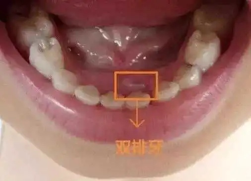 优雅的叶子|牙医拔牙到手软:每天接诊20个双排牙孩子,请家长先停止“宠溺”!