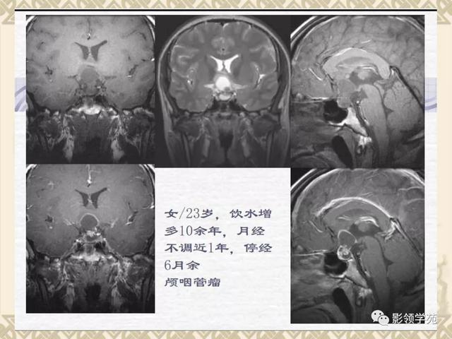 垂体病变的MRI诊断