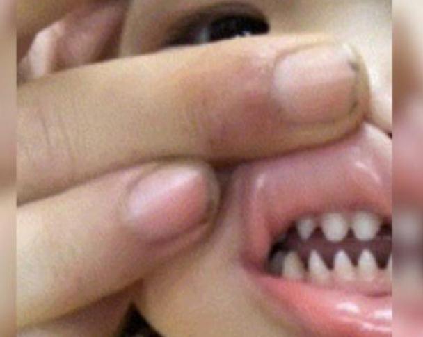 你的育儿经|宝宝长出“鲨鱼牙”，妈妈不敢喂他急忙送医，医生：太晚了