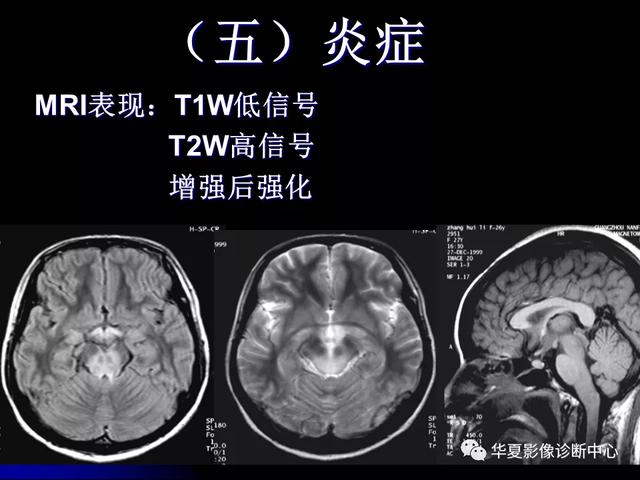 「影像复习」脑干区常见病变影像表现