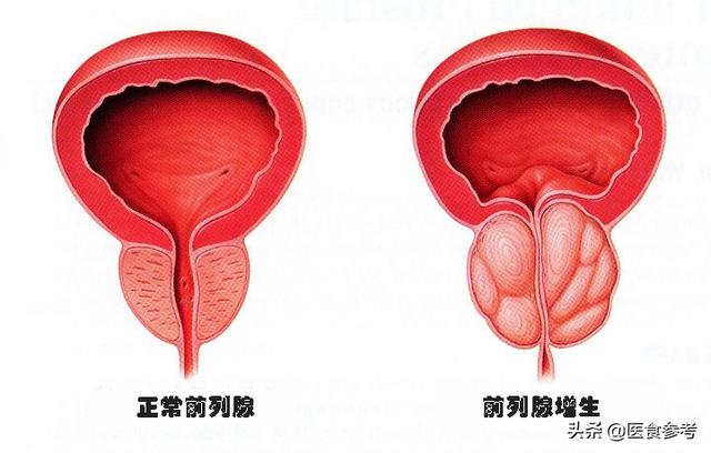 结节、息肉、囊肿、增生...哪个最可能癌变？这么多年疑惑终于解开了！