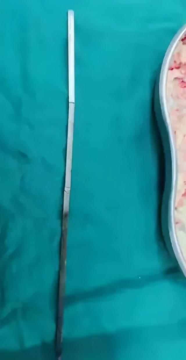 烤肉|怎么吞下去的？男子被20厘米烤肉签穿肺…