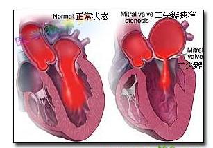 你的育儿经|35岁女子怀孕仨月，突然胸闷气短无法躺卧！医生：这病起病隐匿，孕前检查很必要