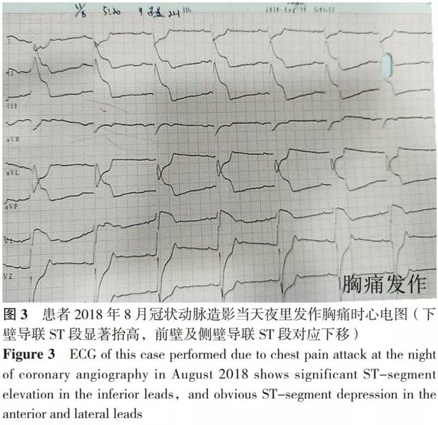 全科诊疗思路——冠状动脉无阻塞病变的变异型心绞痛患者的诊治过程