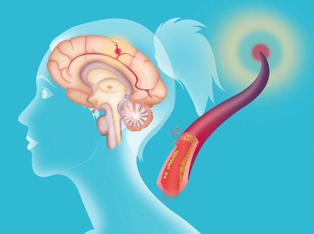 脑梗|这4种表现，十有八九是脑梗在“求救”，尽早去医院