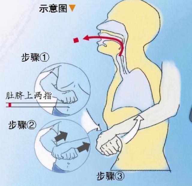 6岁男童讲话频频出现“哨音”，去医院检查竟在体内发现了这个