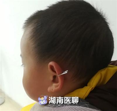 你的育儿经■男童误抠气枪扳机，竟致铁钉穿耳！家有“神兽”您需Get这些知识