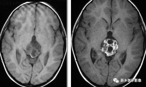 12种松果体区肿瘤的影像表现