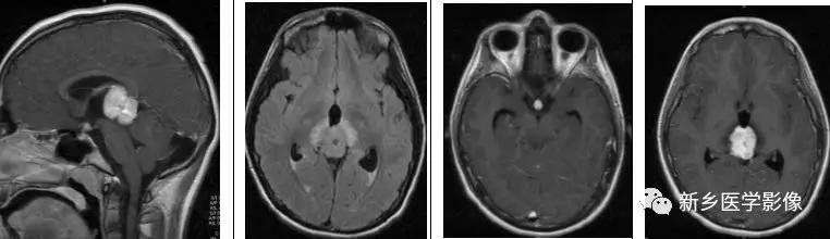12种松果体区肿瘤的影像表现