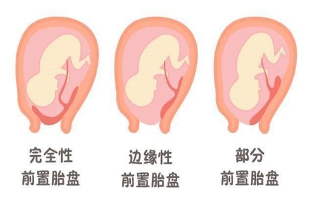 甜蜜妈妈|胎盘位置就能看出胎儿性别？不如抛开迷信，看看科学能判断什么
