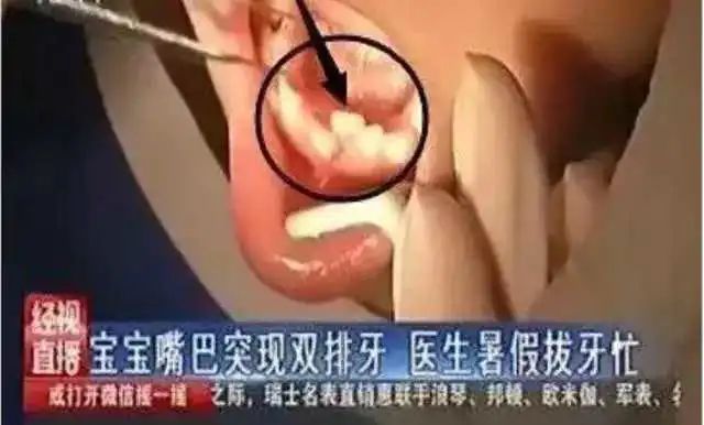 优雅的叶子|牙医拔牙到手软:每天接诊20个双排牙孩子,请家长先停止“宠溺”!