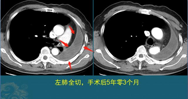 肺癌能治好吗？医生解释3个阶段的治疗数据，避免人财两空