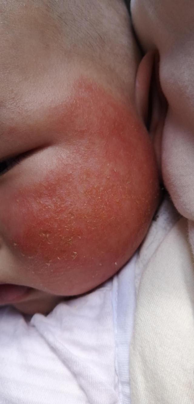 【超级宝妈】新生儿湿疹是常见疾病,如何判断及护理,妈妈们要注意一下几点