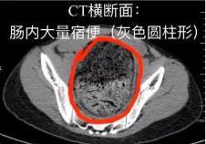 结肠|高二女生腹痛难忍寻医，一次排出8斤……马桶都堵了