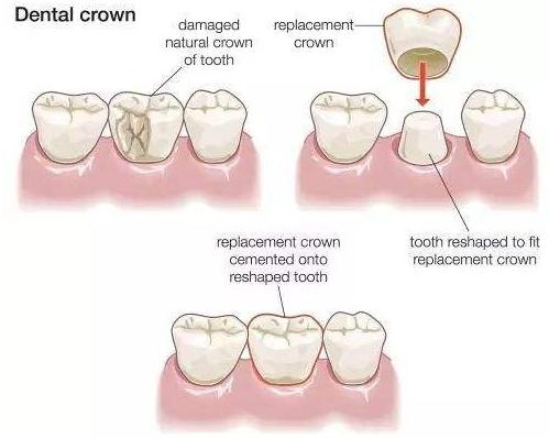 咀嚼功能|牙齿烂了之后，补牙后医生建议要戴牙冠，真的有必要吗？