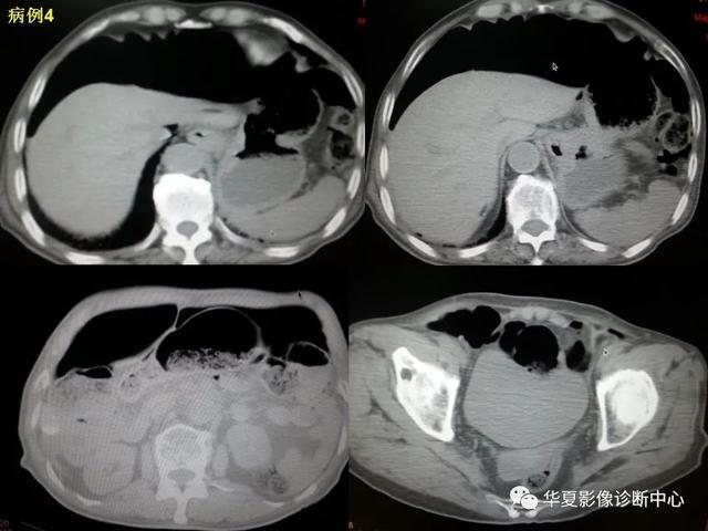 消化道穿孔的CT诊断