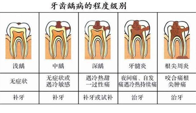 什么是根管治疗？为什么人人都那么害怕？