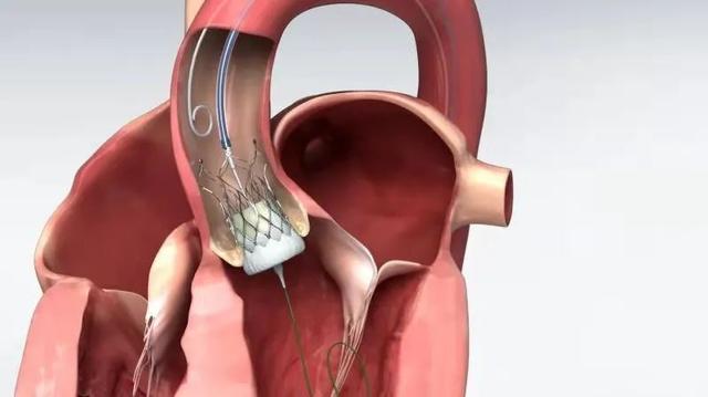 医疗|微创子公司港交所主板上市！“中国方案”守护全球患者“心门”