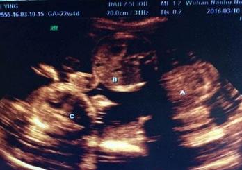 超级宝妈@通过剖腹产生了3个婴儿，但她的婆婆意外地将她骂为“无用”