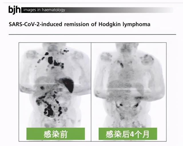 不可思议！癌症晚期患者染新冠4个月后，肿瘤竟然消失了