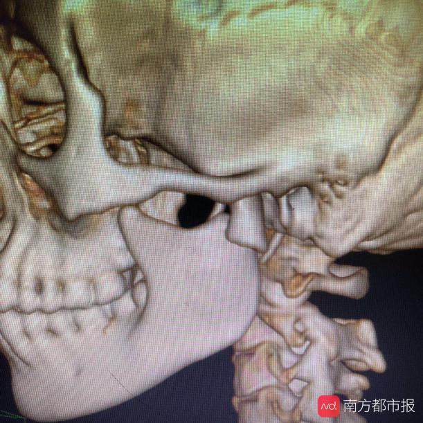 为什么骑车一定要戴头盔？因为下巴骨断了很麻烦