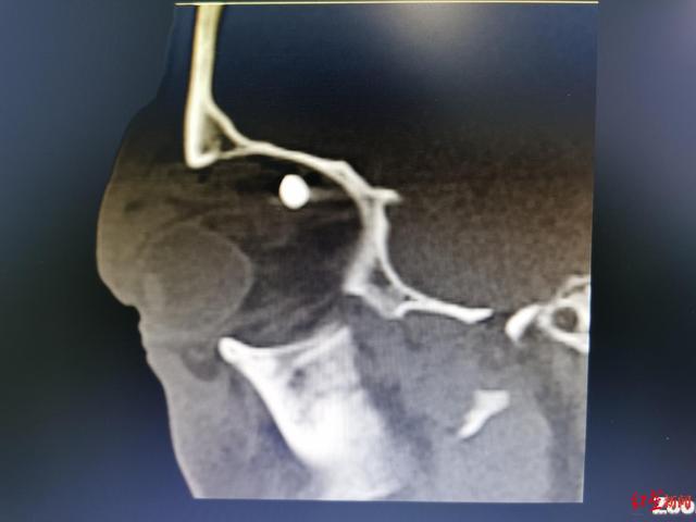 异物|0.7厘米金属渣刺入男子眼眶当场失明 医生挑战高难度手术期待复明奇迹