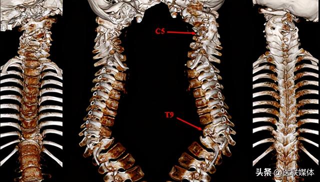 歪脖子背痛警惕脊柱畸形！医生两次手术让她们挺胸抬头，走向新生