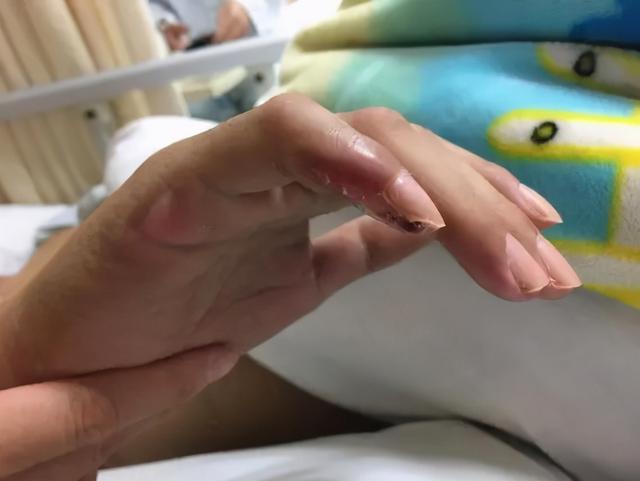 28岁小伙上肢缺血险坏死，医生以大隐静脉移植重建血管通路让他“绝处逢生”