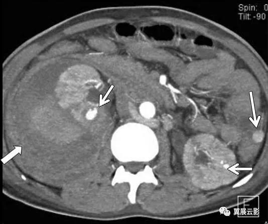 24张图汇总「肾血管」常见病变的影像学表现