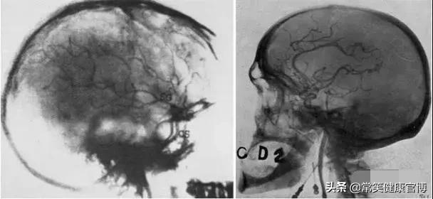 脑血管造影术——诊断脑血管病的“金标准”