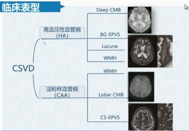 脑小血管病如何诊治？这一篇讲清楚了