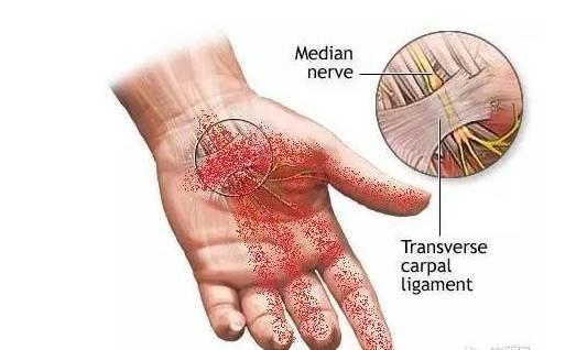 神经|经常手麻的人要注意了，你的身体可能出现了这些问题