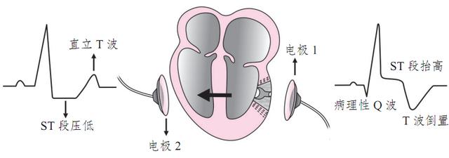 心电图T波改变|辟谣：心电图T波改变就是心肌缺血？医生说，还不一定就是病呢