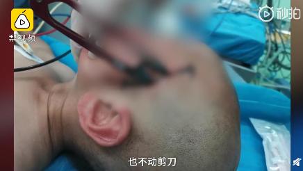 「燕赵都市报」警惕！2岁男童摔倒手中剪刀刺破脑膜，经治疗脱离生命危险