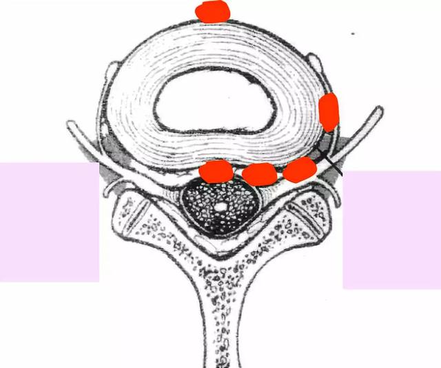 拿到片子不会看？6 种「椎间盘突出」的影像征象需注意