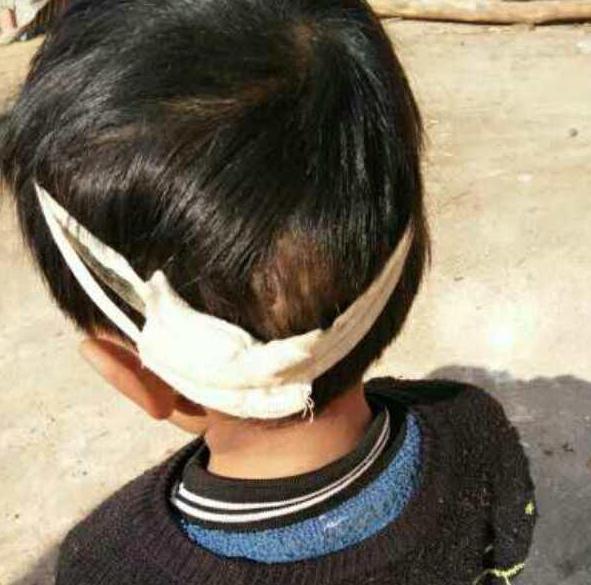 你的育儿经@1.5岁女宝意外磕伤额头，缝5针留大疤，保护宝宝从家庭意外开始