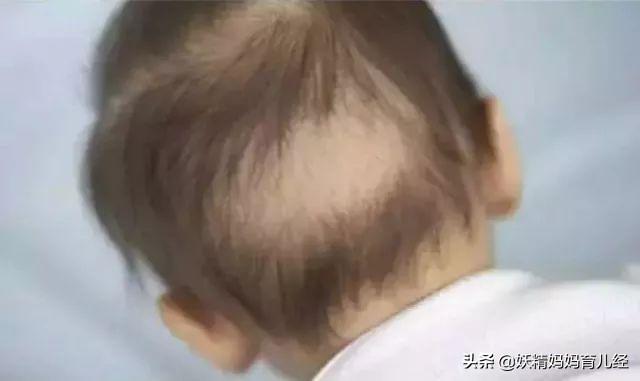超级宝妈|枕秃、盗汗、不长个儿，宝宝缺钙？儿科医生：补错钙，危害更大