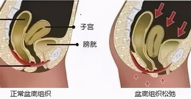 产后尴尬：咳嗽跳绳就漏尿？一个动作可以帮你改善