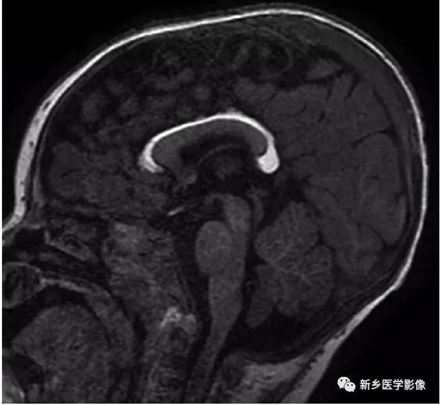 大脑中线处常见的25种疾病