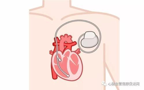 「心的科普」关于起搏器，你所应该知道的那些事……