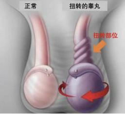 健康直通车:扭转达1080°!岚山区人民医院救治一名睾丸扭转小患者