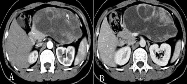 胰腺占位 CT 片不会看？这里一文教你掌握