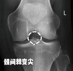 关节腔|晨起双手发胀、僵硬、握不拢，一定是类风湿吗？有没有其他可能呢