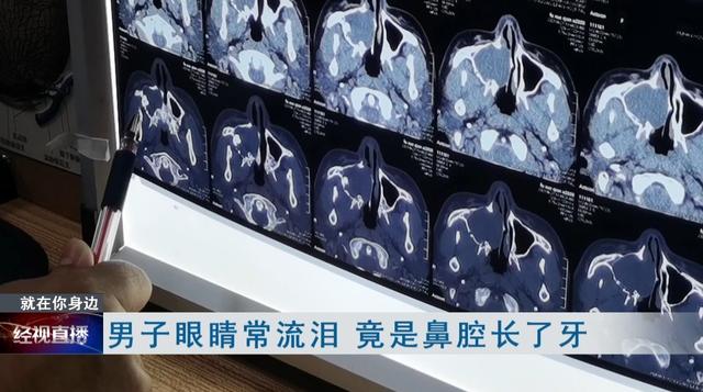 囊肿|惊呆！武汉一男子鼻腔长了牙，医生：从医40年没见过这种情况