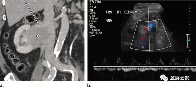 24张图汇总「肾血管」常见病变的影像学表现
