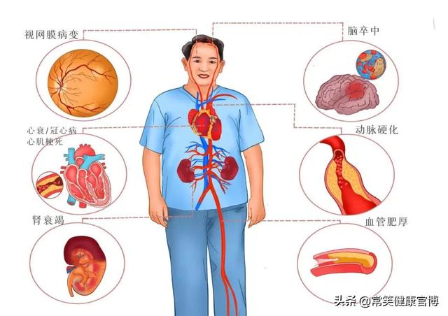 不用吃药的高血压，你也属于这类吗？