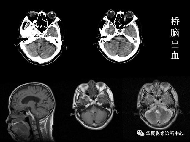 「影像复习」脑干区常见病变影像表现