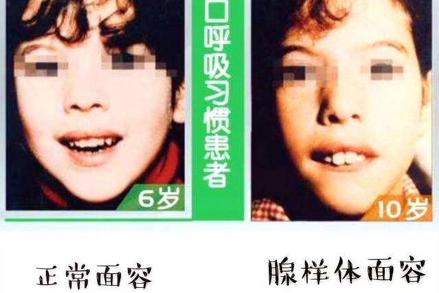 #天使宝贝#孩子“嘴部”越长越难看，不是环境影响颜值，可能是睡觉的坏习惯