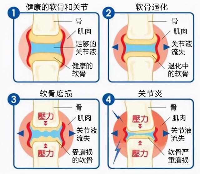 中老年人常受骨关节炎困扰，如何阶梯治疗减轻疼痛避免畸形？